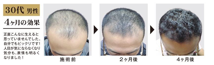 30代 男性 4ヶ月間の発毛・育毛コース施術結果 ビフォーアフター