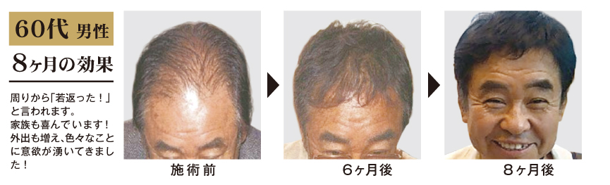 60代 男性 8ヶ月間の発毛・育毛コース施術結果 ビフォーアフター