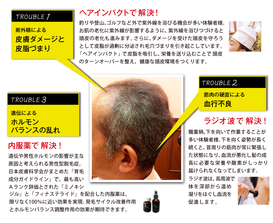 58歳(男性)体験者さまの薄毛の原因は、紫外線による皮膚ダメージと皮脂詰まり、筋肉の硬直による血行不良、遺伝によるホルモンバランスの乱れ（男性型脱毛症ＡＧＡ）